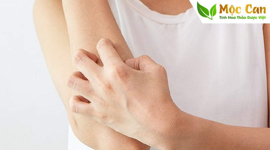 Mụn nhọt, mẩn ngứa ngày hè do “nóng trong nóng ngoài” 1